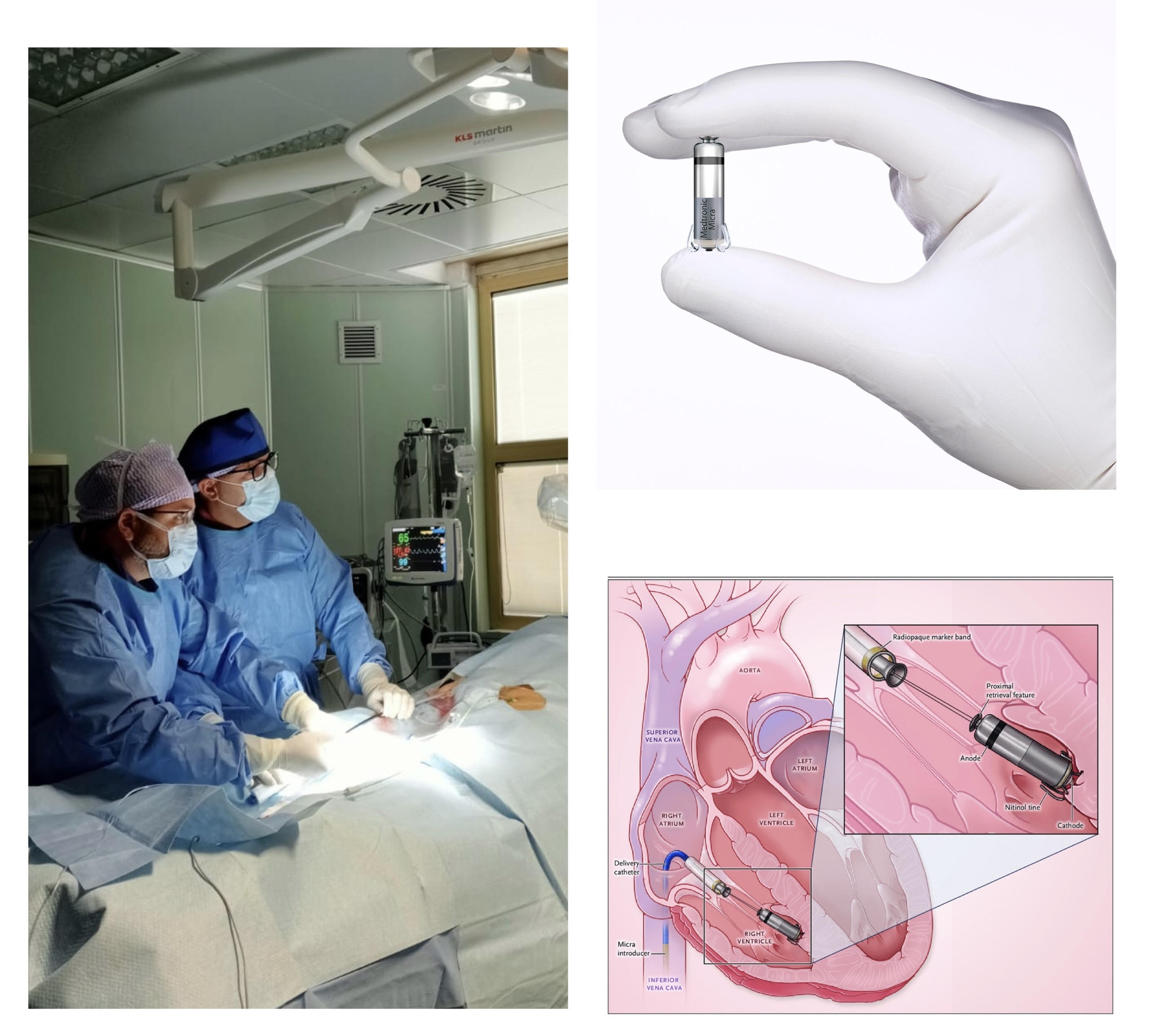 Pacemaker senza fili